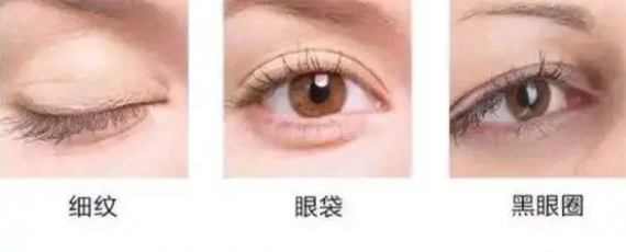 眼袋