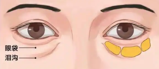 眼袋