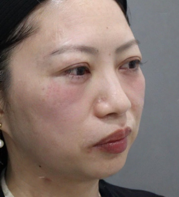 去眼袋手术