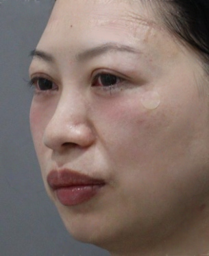去眼袋手术