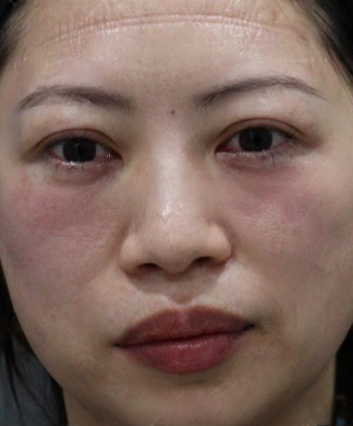 去眼袋手术