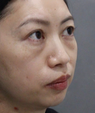 去眼袋手术