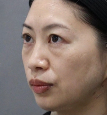 去眼袋手术