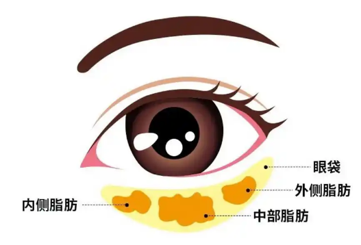 眼袋