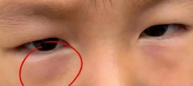 眼袋