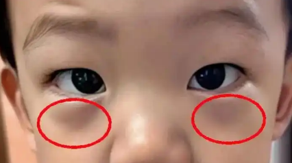 眼袋
