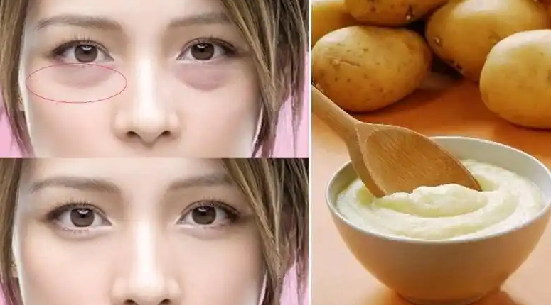 眼袋