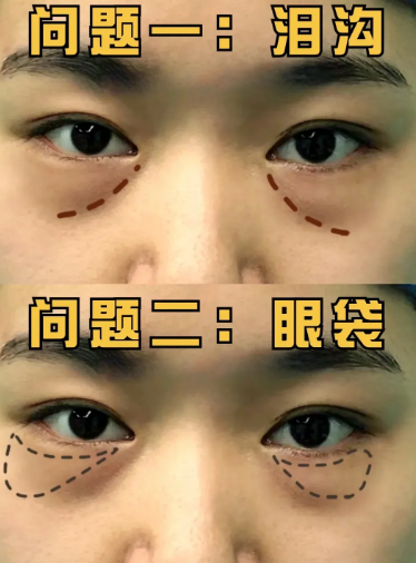 去眼袋手术