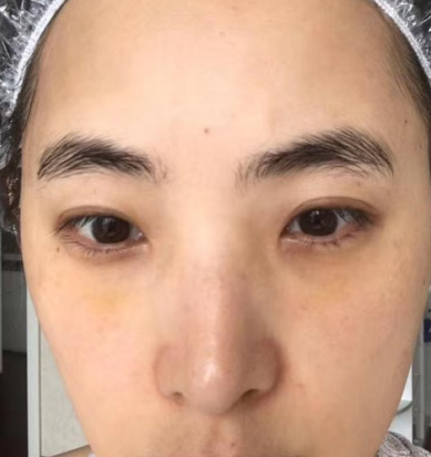 去眼袋手术