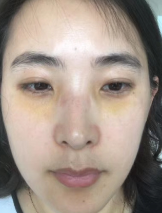 去眼袋手术