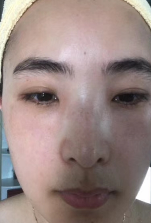 去眼袋手术