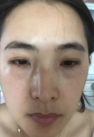 去眼袋手术
