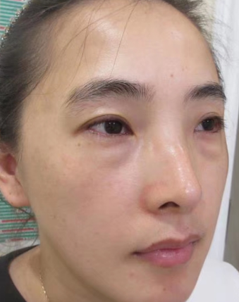 去眼袋手术