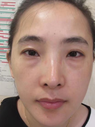 去眼袋手术