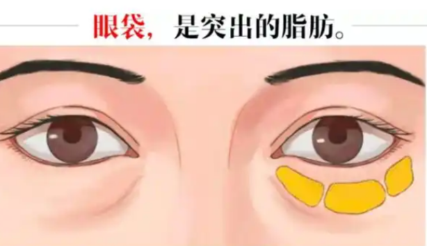 去眼袋手术