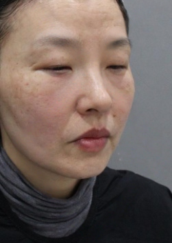去眼袋手术