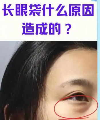 眼袋