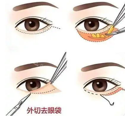 眼袋