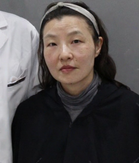 去眼袋手术