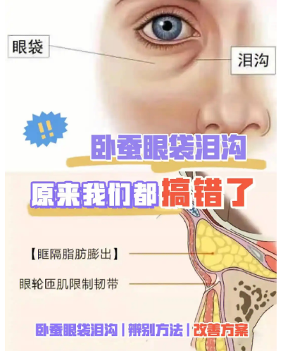 去眼袋手术