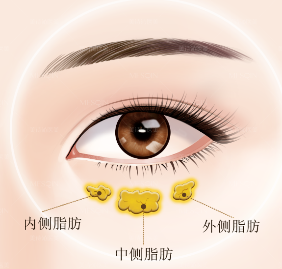 去眼袋手术