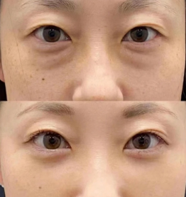 眼袋