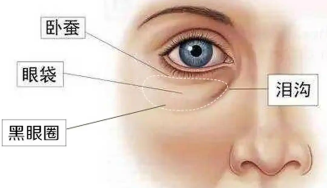 眼袋