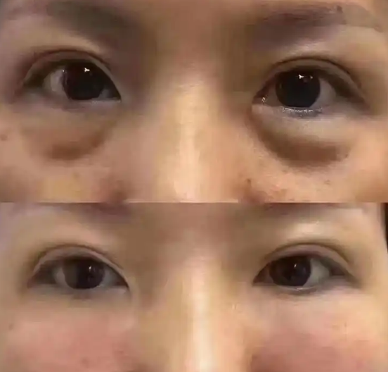 眼袋