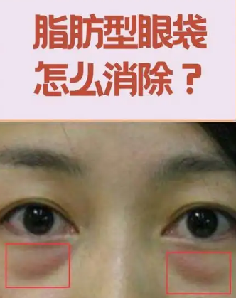 眼袋