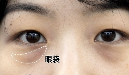 去眼袋手术