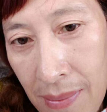 去眼袋手术