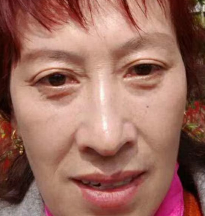 去眼袋手术