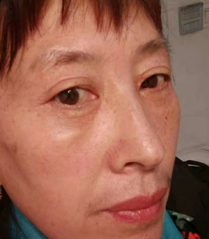 去眼袋手术