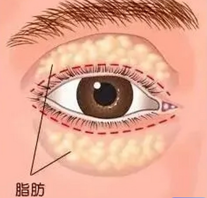 去眼袋手术