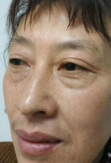 去眼袋手术