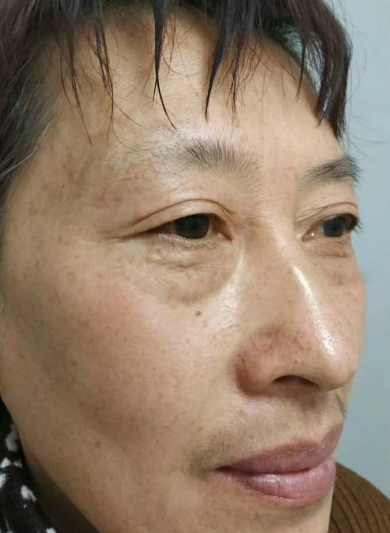 去眼袋手术