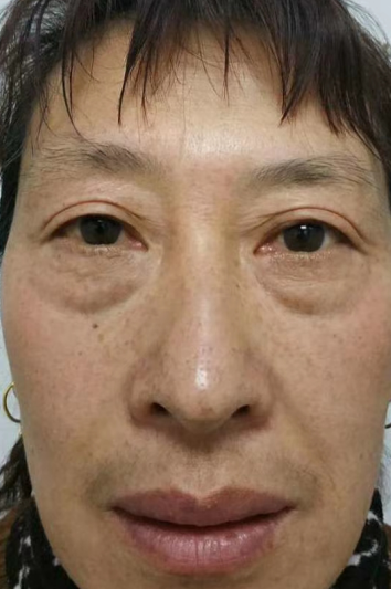 去眼袋手术