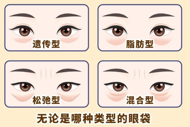去眼袋手术