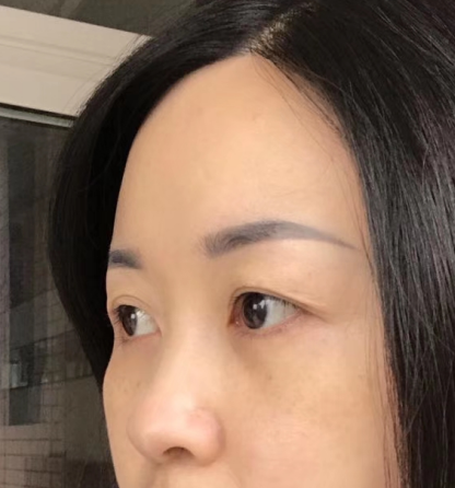 去眼袋手术