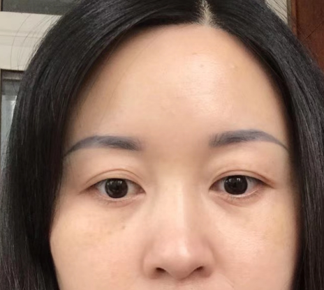 去眼袋手术