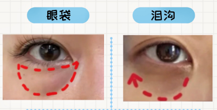 去眼袋手术