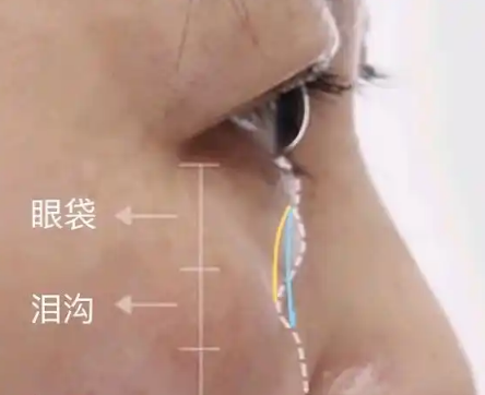 去眼袋手术
