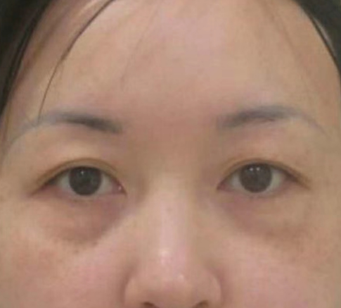 去眼袋手术