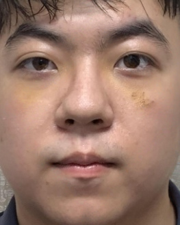 去眼袋手术