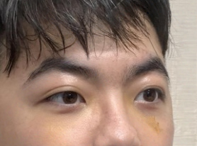 去眼袋手术
