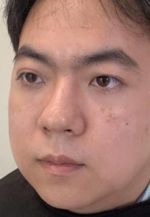 去眼袋手术