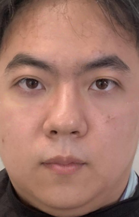 去眼袋手术
