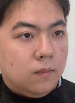 去眼袋手术