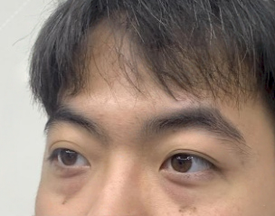 去眼袋手术
