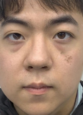 去眼袋手术